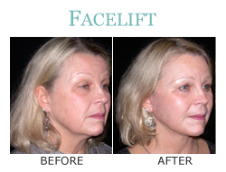 Face Lift Surgery Before and After