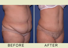 Long Term Weight Loss After Seattle Tummy Tuck