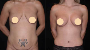 Seattle Breast Lift Tummy Tuck Labiaplasty
