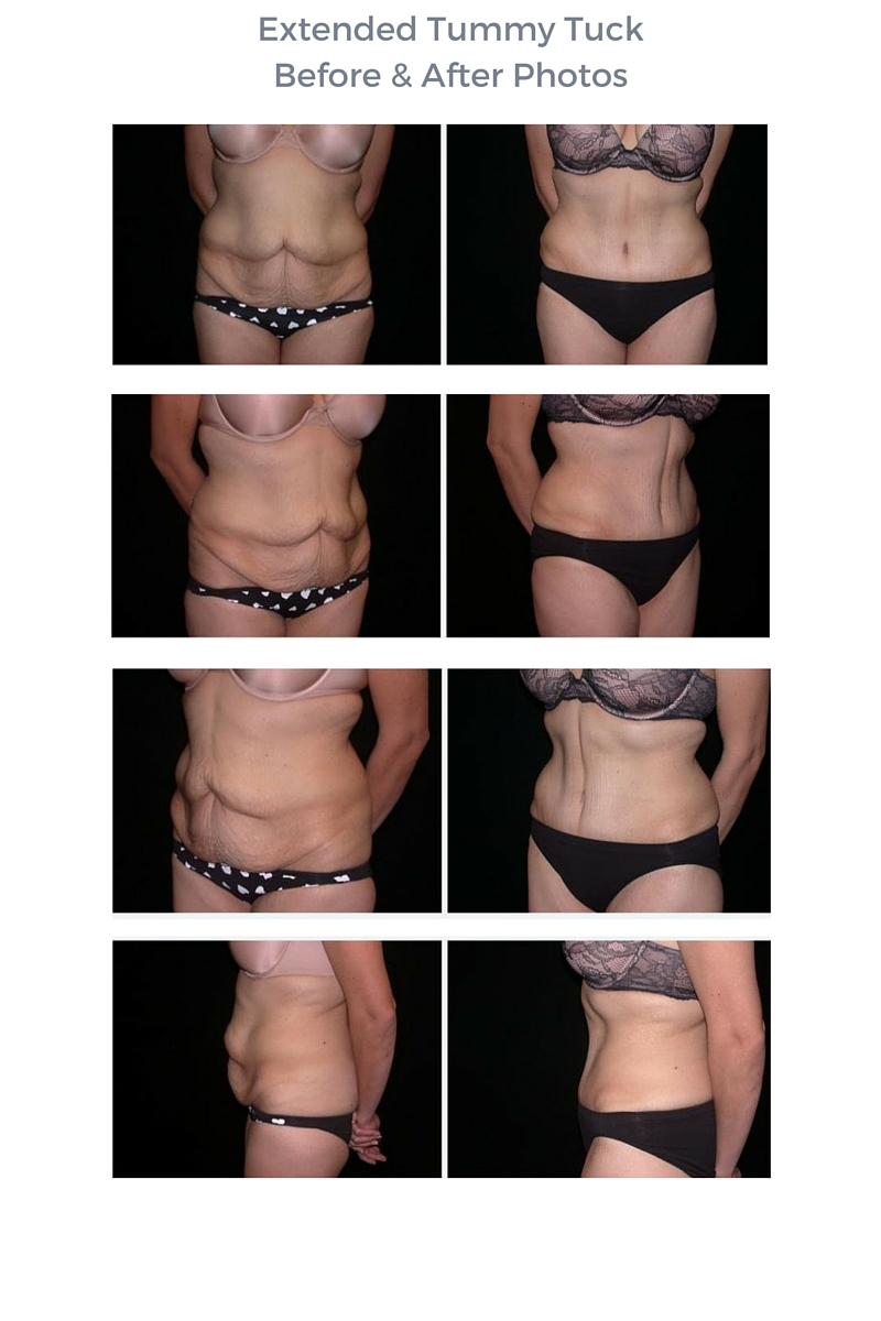 Seattle Extended Tummy TuckBefore & After Photos (Case 8)