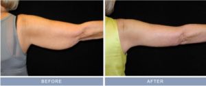 arm-lift-brachioplasty-and-liposuction