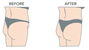 Illustration of a Brazilian Butt Lift Example Before & After