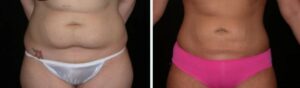 Belly Fat Removal Before & After Photo Liposuction Case 7