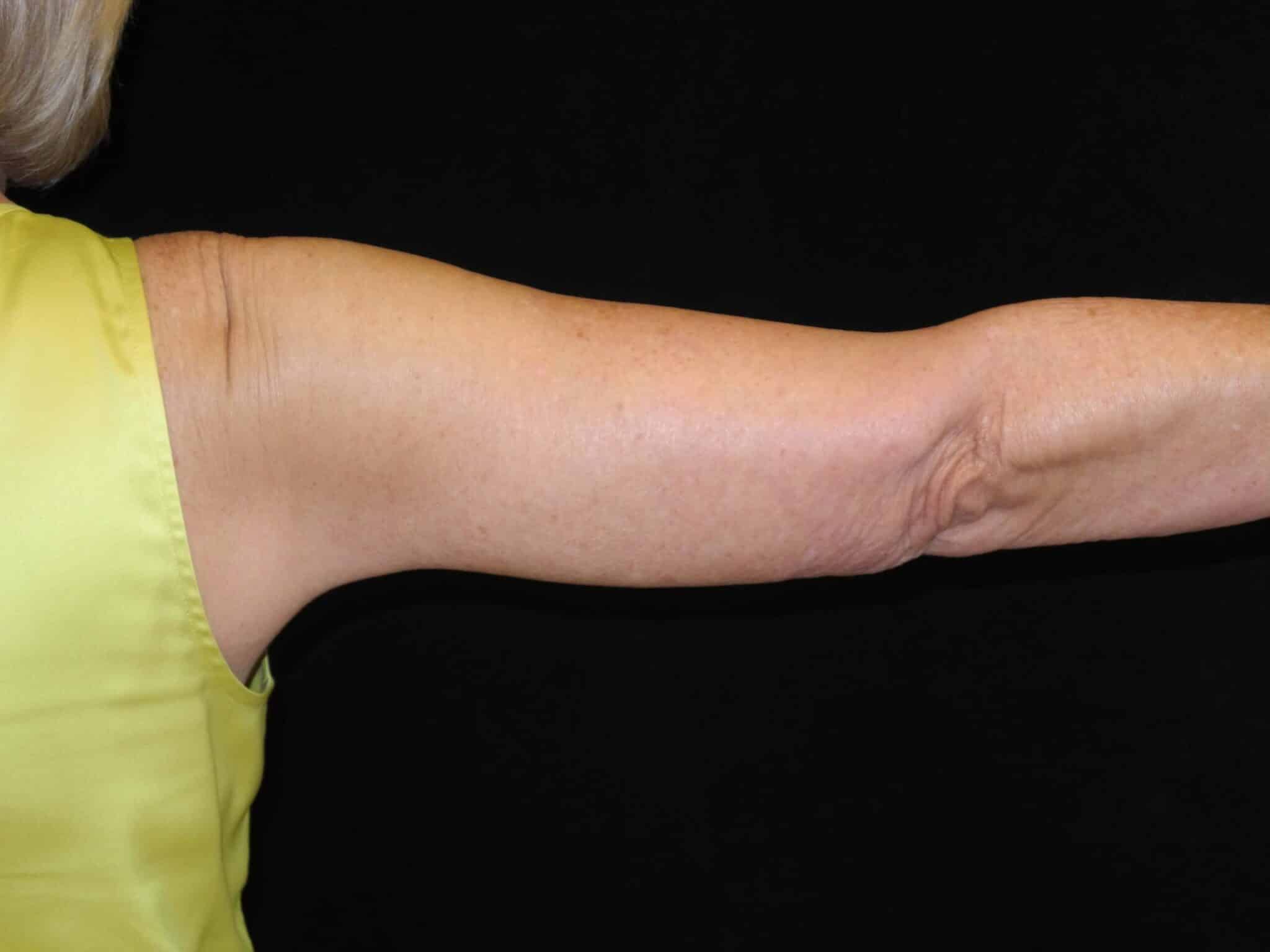 Arm Lift - Right arm straightened outer after - thumbnail