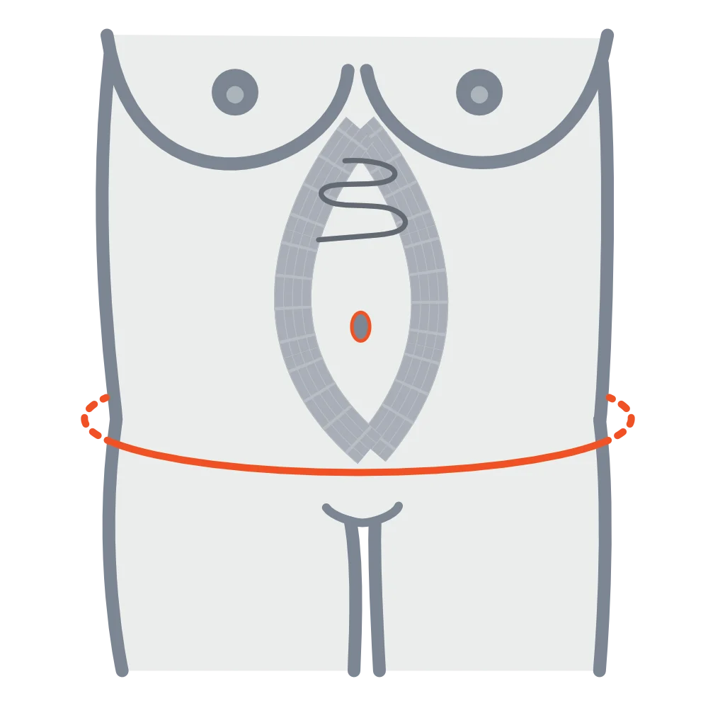 Extended Tummy Tuck