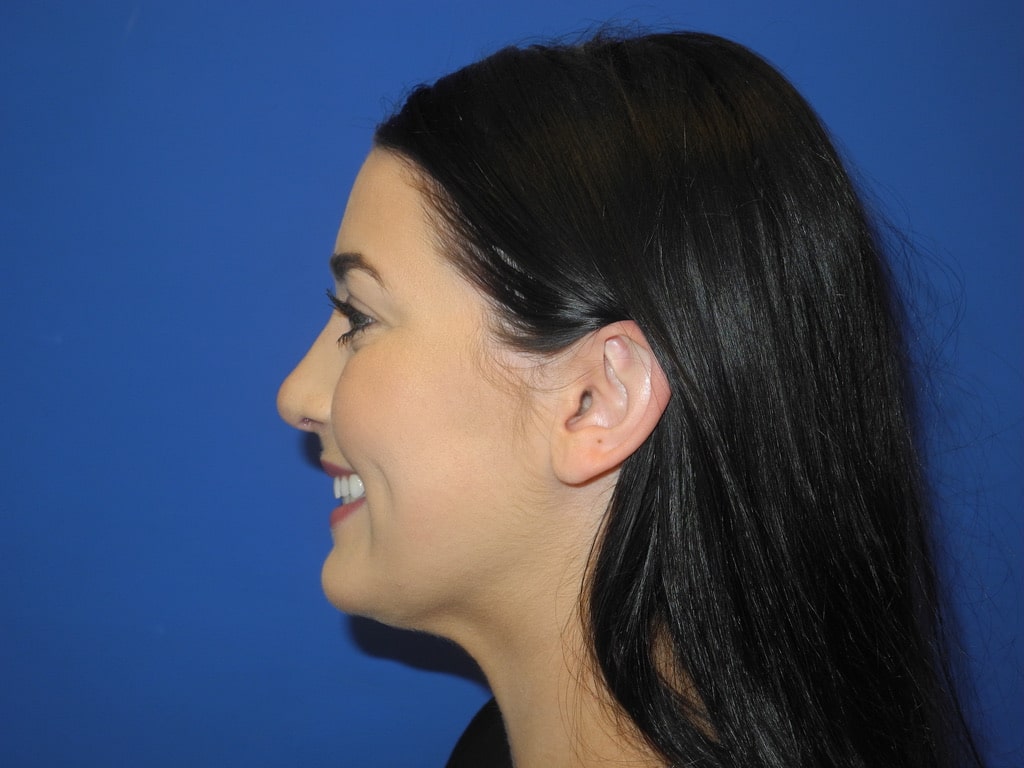 Rhinoplasty Case31TN left lateral smiling postop