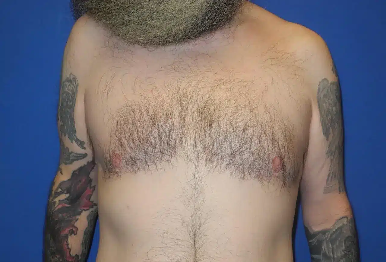 Male Breast Reduction Postop