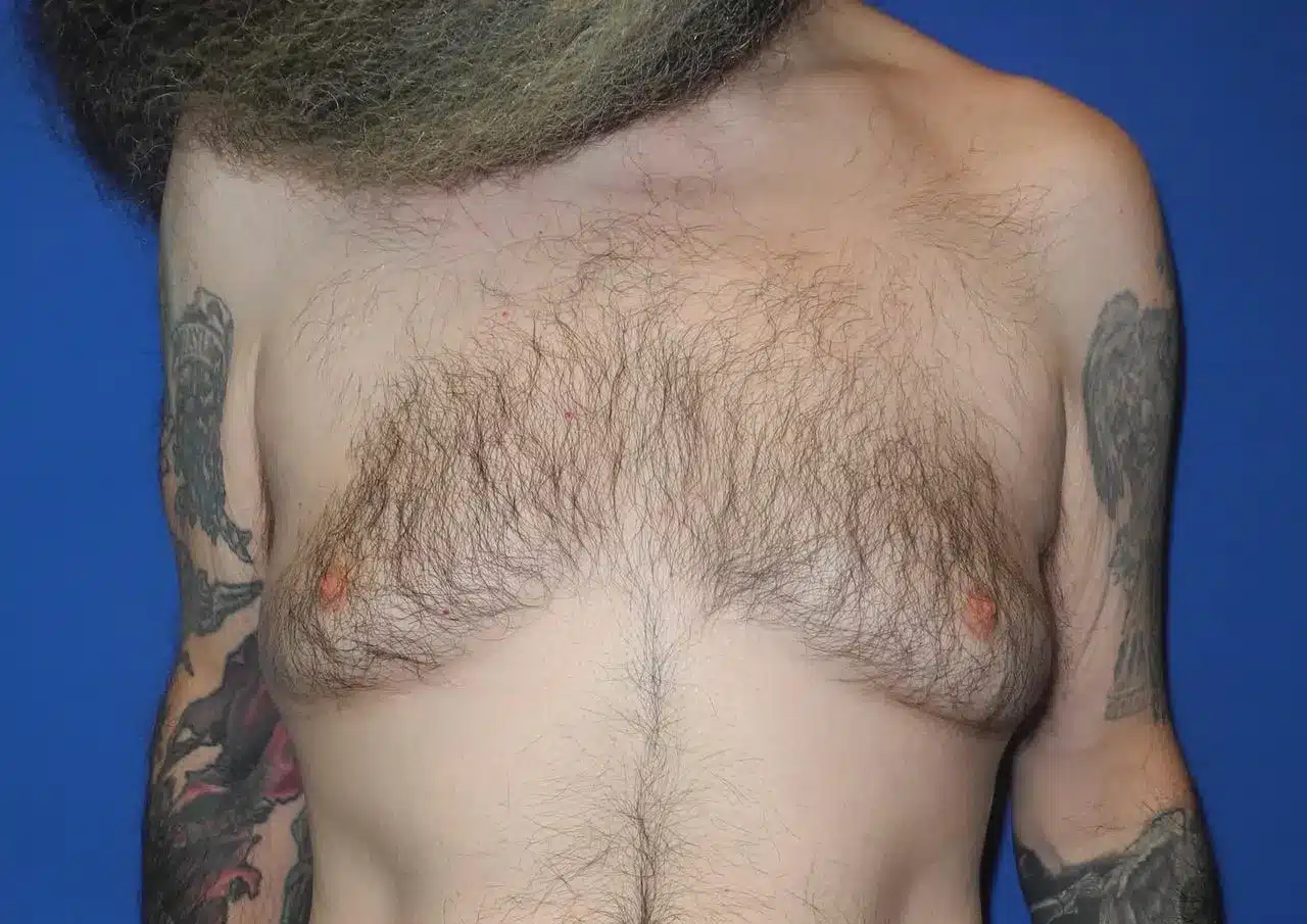 Male Breast Reduction Preop